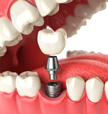 Animation of implant supported dental crown