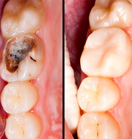 Closeup of tooth with cavity before and after tooth-colored filling