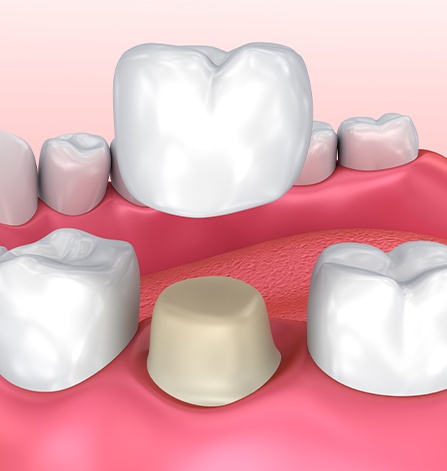 Animation of dental crown placement