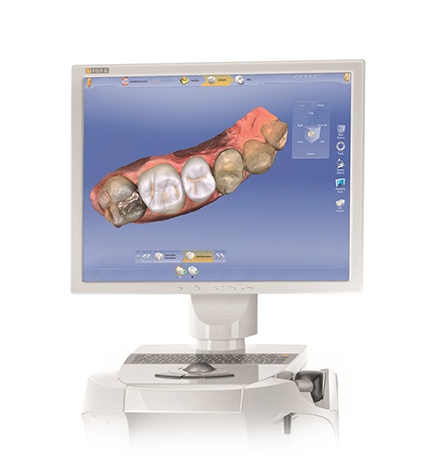 CEREC impressions on chairside computer