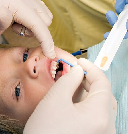 Child receiving fluoride treatment