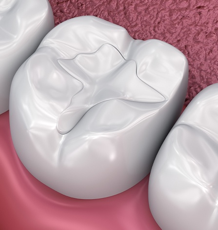 Animation of tooth with filling