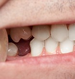 Closeup of smile with missing tooth