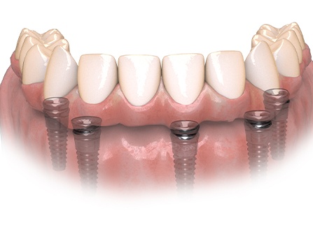 replica of hybridge teeth lower