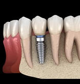 Animation of implant supported dental crown