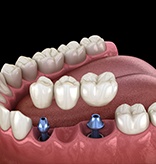 Animation of implant supported fixed bridge