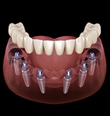 Animation of implant supported denture