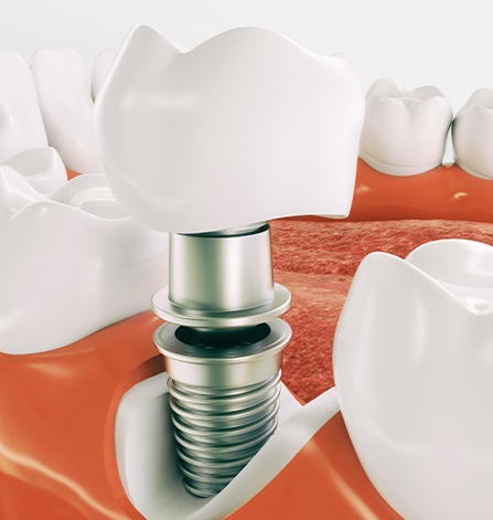 Animation of dental implant tooth replacement components