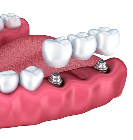 Animation of fixed bridge placement