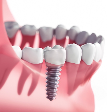 Animation of implant supported dental crown