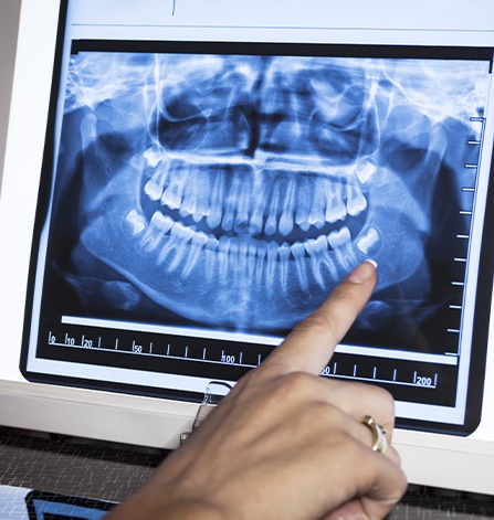 Panoramic digial x-rays on chairside computer